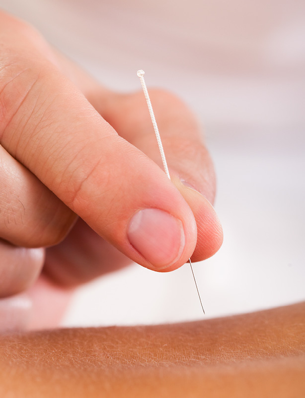 Acupuncture, Osteopathy Treatment, Body Plus Osteopath Essex